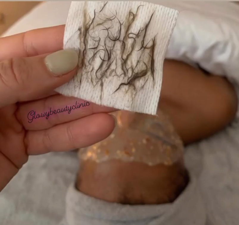 Vaxning hårborttagning — Glowy Beauty Clinic