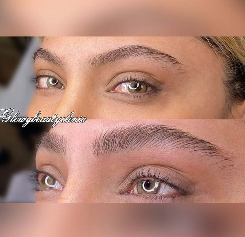 Brynbehandling före och efter — Glowy Beauty Clinic