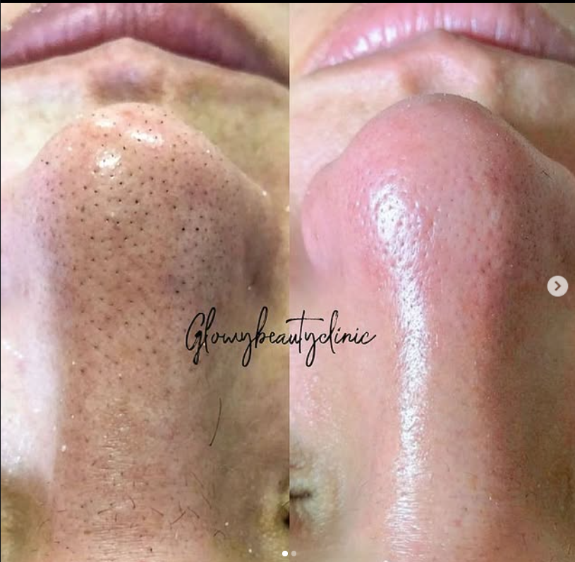 Porrengöring näsa före och efter — Glowy Beauty Clinic
