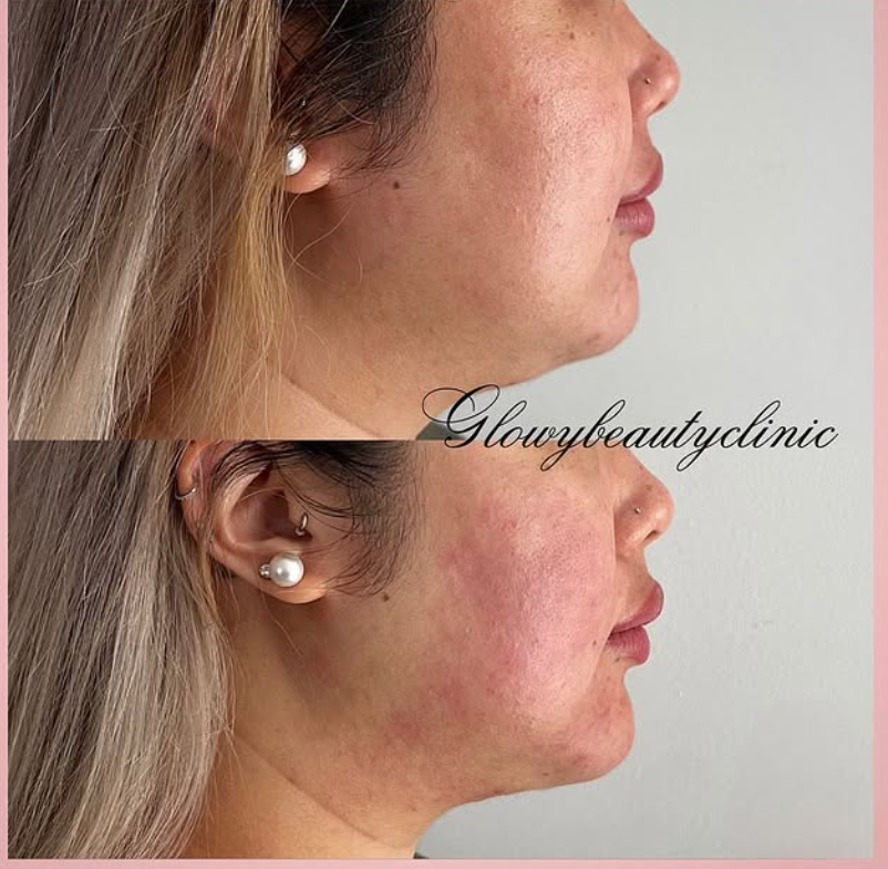 HIFU resultat — Glowy Beauty Clinic