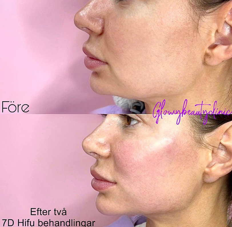7D HIFU före och efter — Glowy Beauty Clinic
